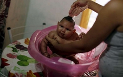 Mỹ chính thức xác nhận virus Zika gây dị tật thai nhi bẩm sinh