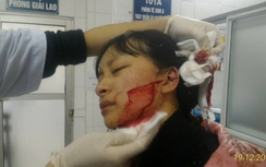 Mâu thuẫn nhỏ, nữ sinh lớp 11 bị đâm rách mặt