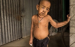 Sốc cảnh bé 4 tuổi sống trong hình hài 80 tuổi