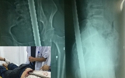 Cứu sống một người bị thanh sắt 2m đâm xuyên lưng