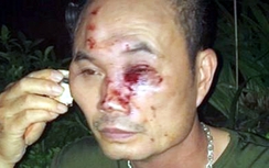 Bảo vệ chung cư bị nhóm côn đồ hành hung nhập viện