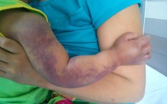 Bộ trưởng Y tế "nhờ" BV Bạch Mai cứu cháu bé bị rắn cắn