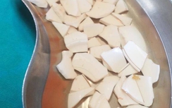 Gắp 59 mảnh sành trong bụng bệnh nhân "ăn" chén vỡ