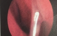 Trẻ 3 tuổi viêm màng não mủ vì nhiễm trùng dị vật trong mũi