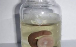 Gắp con vắt sống ngoe nguẩy trong mũi bệnh nhân