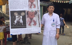 Bộ trưởng Tiến chỉ đạo cứu hai bé sơ sinh dính liền