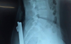 Nữ sinh 16 tuổi bị thanh sắt đâm xuyên người