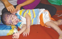 Bác sĩ Nhi khoa hướng dẫn cách chăm sóc trẻ mắc thủy đậu