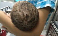 Tắm lá chữa thủy đậu, bé trai 4 tuổi bị nhiễm độc da