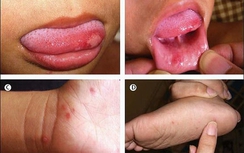 Cùng sốt xuất huyết, lo ngại bùng phát dịch tay chân miệng