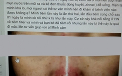 Sau tiêm filler 2 ngày, mũi cô gái sưng tấy, nổi mụn nước