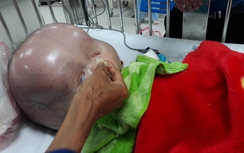 Xót lòng bé trai mắc não úng thủy chậm nhập viện vì hủ tục