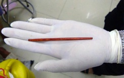 Hy hữu: Nam bệnh nhân tự chọc đũa vào dương vật