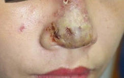 Hãi hùng mũi chảy mủ vì... tiêm filler nâng mũi