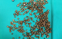 400 viên sỏi ken chặt trong túi mật của nữ bệnh nhân