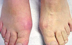 Chế độ ăn uống ngày Tết của người mắc bệnh gout
