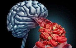Nhồi máu não đến quá nhanh, nhận biết được 5 triệu chứng sẽ tự cứu sống mình