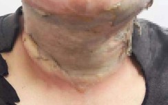 Người đàn ông bỏng nặng sau khi lau người bằng cồn để chống virus Corona