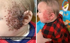 Xót xa trước hình ảnh mặt em bé nổi đầy mụn rộp do thói quen hôn hít của người lớn