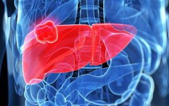 3 dấu hiệu ở miệng giúp "tiên đoán" ung thư gan