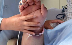 Dấu hiệu này xuất hiện trên bàn tay, người đàn ông phát hiện ung thư phổi