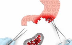 Bí quyết tránh xa ung thư dạ dày: Ăn ít "4 món" và không làm "3 việc"