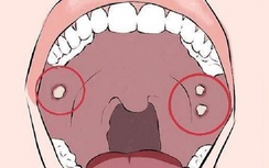 5 triệu chứng bất thường cho thấy bạn đang có nguy cơ mắc ung thư miệng