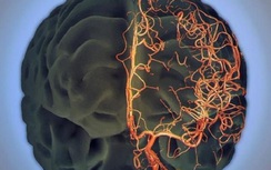 Người phụ nữ 45 tuổi bị nhồi máu não do sở thích ăn uống nhiều người có