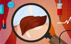 4 kiểu người dễ trở thành mục tiêu của ung thư gan, liệu có bạn trong đó?
