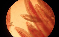 Thanh niên 31 tuổi bị đau bụng, bác sĩ phát hiện đàn "bọ" trong gan