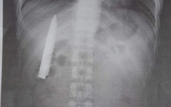 Đi khám vì tức ngực, người đàn ông sốc khi thấy lưỡi dao trong ngực