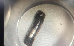 Bé trai nuốt phải dị vật gây thủng dạ dày, thứ này không nên để trẻ chơi