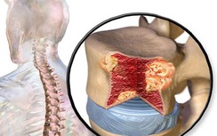 Đây là loại khối u dễ chẩn đoán sai nhưng có tỷ lệ tử vong cao