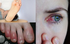 Thêm 2 dấu hiệu sớm của bệnh COVID-19 trước cả sốt, ho, khó thở