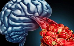 Trắc nghiệm: Đột quỵ tăng cao mùa nắng nóng, ai cũng phải biết kẻo "hối không kịp"