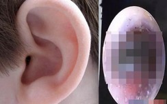 Đeo tai phone quá nhiều, cậu bé bị nấm mọc trong lỗ tai