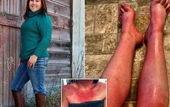 Mắc bệnh lạ, người phụ nữ cứ đụng vào nước là toàn thân "đỏ rực"