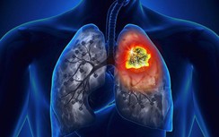 Cả đời không hút một điếu thuốc vẫn bị ung thư phổi vì lý do này