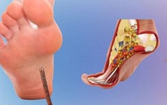 Video: Sơ cứu đúng cách khi giẫm phải vật sắc nhọn gây chảy máu chân