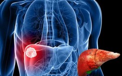 Thấy những dấu hiệu này cần lập tức đi khám để cứu lấy lá gan của bạn