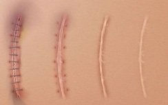 Những khám phá về chỉ phẫu thuật khiến bạn phải thốt lên "thật kì diệu"