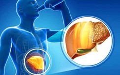 Trắc nghiệm: Người hay uống rượu bia phải biết những điều này để bảo vệ lá gan rất dễ bị tổn thương