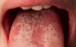 Thấy lưỡi đốm trắng bất thường nhất định phải chú ý 6 điều này