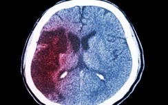 Xuất huyết não “giết người nhanh nhất”, 4 dấu hiệu trước khi khởi phát nhưng dễ bị bỏ qua