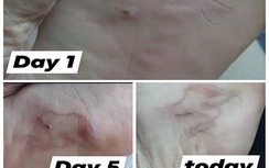 Kinh hoàng phát hiện giun bò loằng ngoằng dưới lòng bàn chân sau khi đi biển về