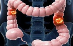 "Thần dược" ngăn ung thư trực tràng giá rẻ như bèo, mua đâu cũng được