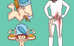 Bác sĩ tiết lộ cách chữa bệnh đau cột sống cực hiệu quả không cần dùng thuốc
