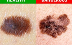 Nốt ruồi trên người có 5 đặc điểm này chứng tỏ bạn đang mắc bệnh nguy hiểm