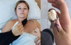 Thói quen cắn móng tay khiến cô gái trẻ suýt mất mạng và phải cắt cụt ngón tay