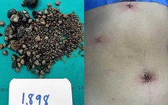 Bác sĩ gắp ra gần 2.000 viên sỏi mật trong bụng cụ bà 60 tuổi bị táo bón